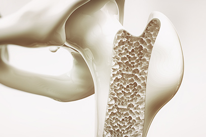 骨粗鬆症